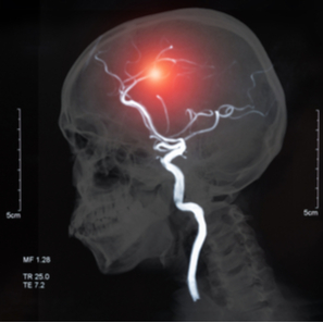 A New Study Examines Cerebrovascular Events in Lupus Patients.